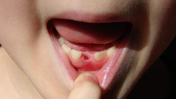 Dentición Dentición