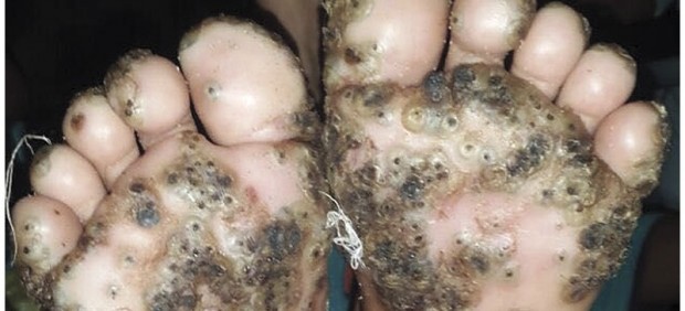 niña que sufrió tungiasis