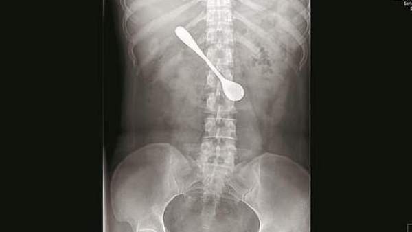 La radiografía de la mujer china con la cuchara en su cuerpo La radiografía de la mujer china con la cuchara en su cuerpo