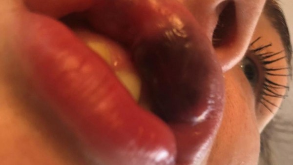 Relleno de labios Relleno de labios