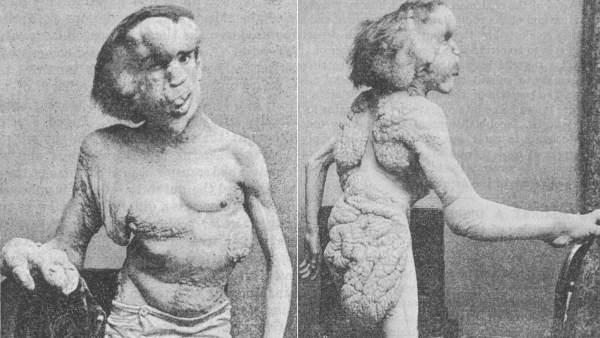Joseph Merrick Joseph Merrick