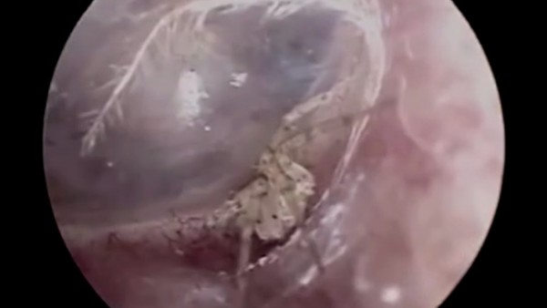 Araña en un oído Araña en un oído