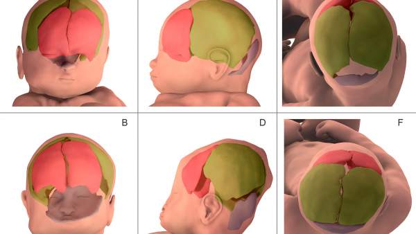 Cráneo fetal Cráneo fetal