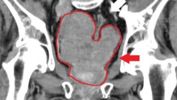 Cáncer de próstata Cáncer de próstata