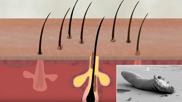 Demodex folliculorum Demodex folliculorum