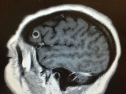 Escáner que muestra el cráneo con la tenia (el círculo que se diferencia en el cerebro).