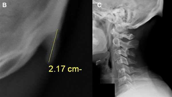 Dos radiografÃ­as donde se ve el 'cuerno' que crece por mirar el mÃ³vil