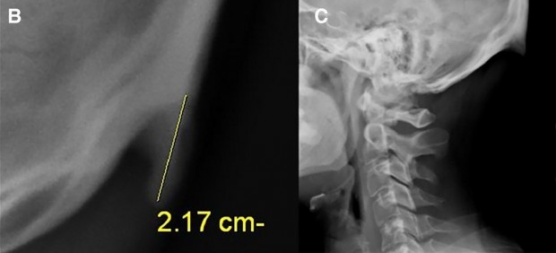 Dos radiografas donde se ve el 'cuerno' que crece por mirar el mvil