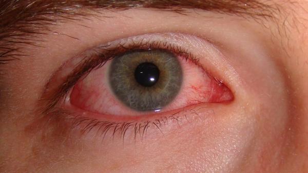 Conjuntivitis Conjuntivitis