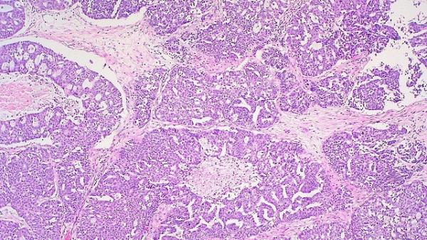 Cáncer de ovario Cáncer de ovario