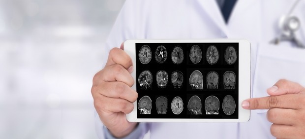 Alzheimer