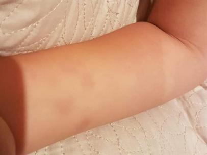Foto de los daños físicos de la menor compartido por su madre en redes sociales.