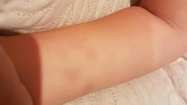 Foto de los daños físicos de la menor compartido por su madre en redes sociales. Foto de los daños físicos de la menor compartido por su madre en redes sociales.