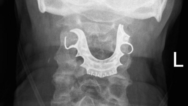 Dentadura postiza en la garganta Dentadura postiza en la garganta