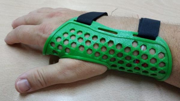 Férula de rectificación. Investigadores de la UPCT desarrollan una silla de rehabilitación y adaptadores de juguetes con tecnología 3D Férula de rectificación. Investigadores de la UPCT desarrollan una silla de rehabilitación y adaptadores de juguetes con tecnología 3D