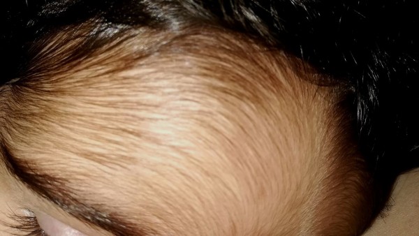 Imagen de la pequeña en la que se aprecian las consecuencias del omeprazol contaminado Imagen de la pequeña en la que se aprecian las consecuencias del omeprazol contaminado