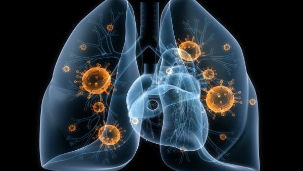 Cáncer de pulmón Cáncer de pulmón