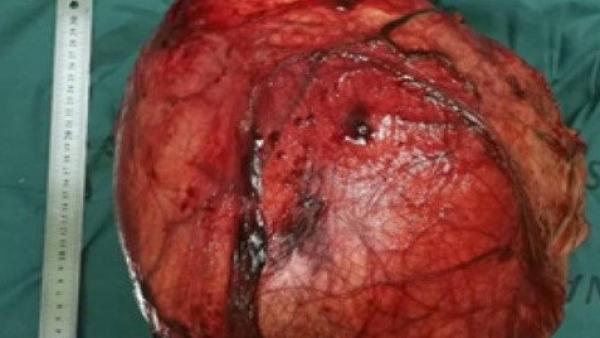 Un quiste renal de más de 12 kilos.