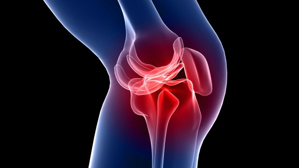Rodilla inflamada Rodilla inflamada